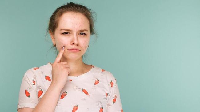 Cara Menghilangkan Noda Hitam Bekas Jerawat Dengan 7 Bahan Alami