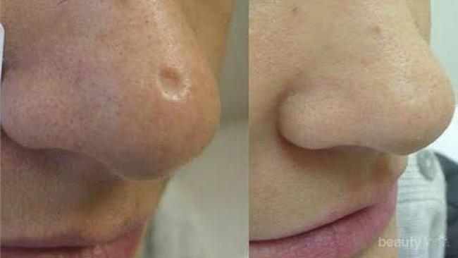 Forum Info Dong Obat Ampuh Penghilang Bekas Cacar Beserta Bopengnya