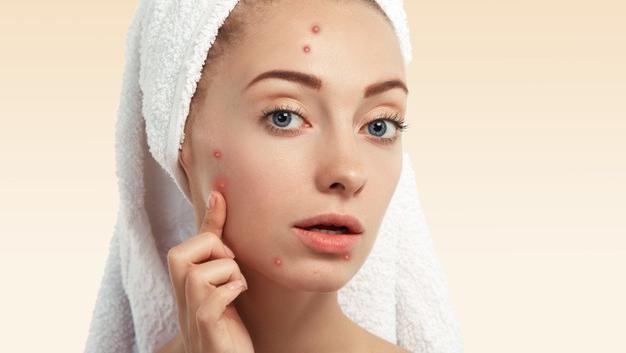 Ampuh Banget 4 Bahan Alami Ini Hilangkan Bekas Jerawat Membandel