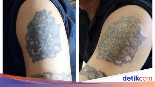 Penampakan Before-After Gambar di Lengan Fauzi Peserta Hapus Tato Gratis