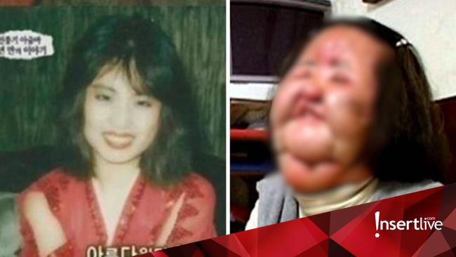 Kisah Tragis Aktris Korea Terkenal yang Wajahnya Hancur usai Oplas