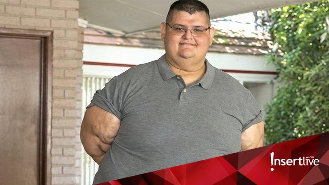 Tragis, Pria Tergemuk di Dunia Meninggal Usai Idap Penyakit Ini