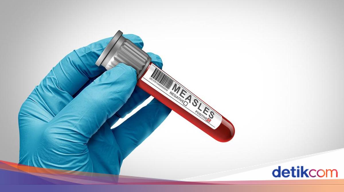 Data Kasus Campak di Banten: 4.456 Suspek, 157 Positif, 6 Pasien Meninggal