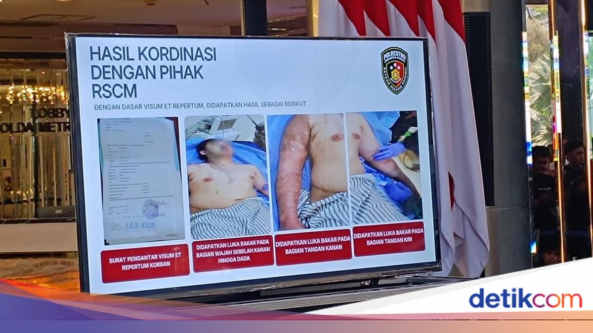 RSCM Ungkap Kondisi Luka Bakar Andrie Yunus Membaik Signifikan