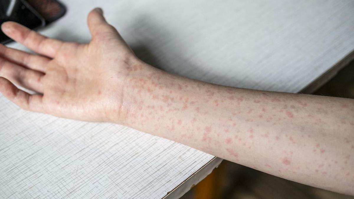 Bukan Cuma Ruam Merah, Komplikasi Campak Bisa Berujung Kena Pneumonia