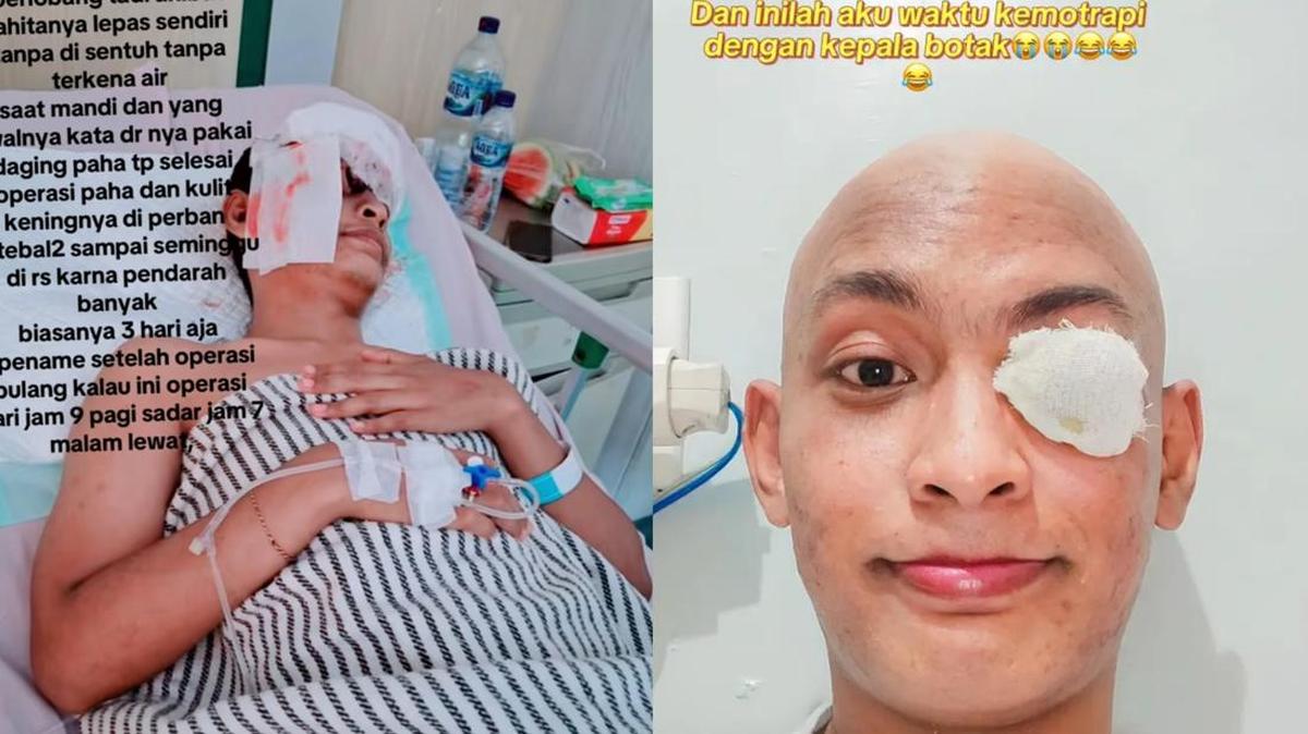 Viral Pria Medan Angkat Bola Mata gegara Kena Kanker, Inikah Penyebabnya?