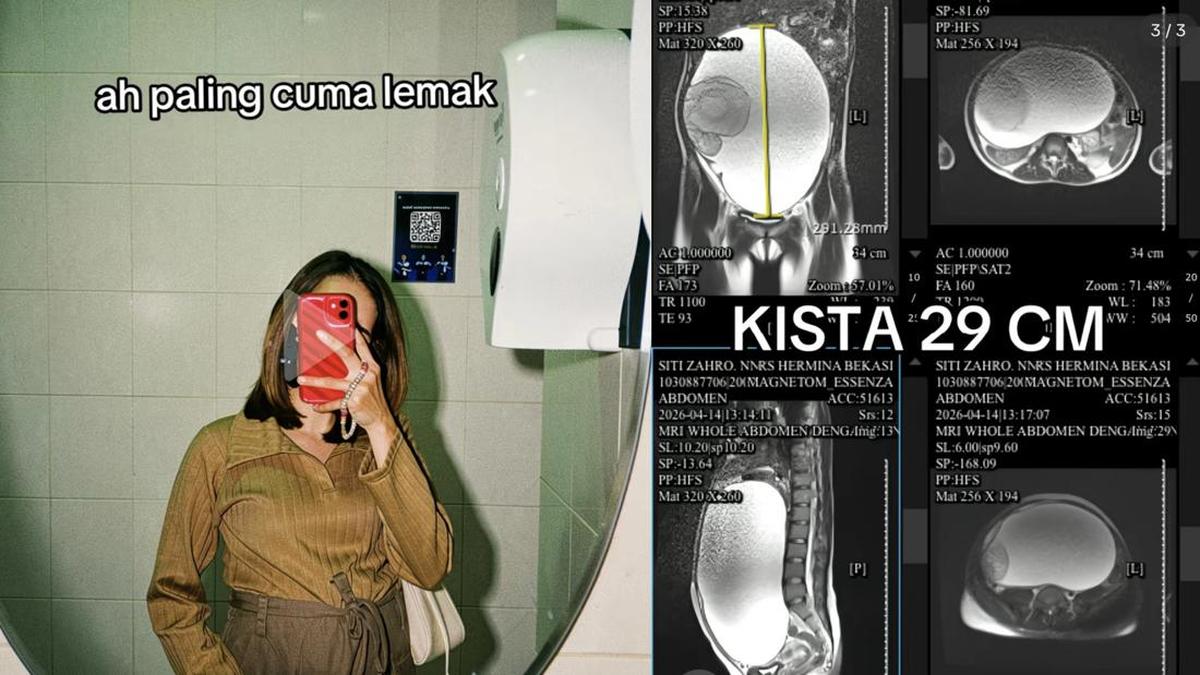 Wanita Bekasi Usia 23 Kena Kista Ovarium Sebesar 29 Cm, Ngaku Hobi Makan Ini