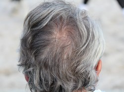 Dokter Sebut Stres Jadi Faktor Risiko Kanker Muncul Kembali