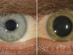 Risiko Penyintas Ebola, Mulai dari Nyeri Sendi Hingga Kebutaan