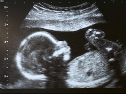 Risiko Bayi Lahir dengan Berat Badan Rendah Bisa Dideteksi dengan USG