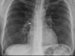 Inhaler Lupa Ditutup, Wanita Ini Tersedak Anting yang Masuk ke Dalamnya