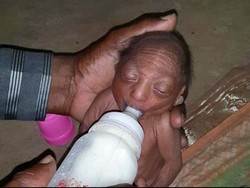 Terlahir dengan Wajah Keriput, Bayi di India Ditelantarkan Orang Tuanya