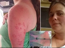 Idap Alergi Sinar Matahari, Kulit Wanita Ini Meleleh Tiap Keluar Rumah