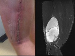 Dikira Berotot, Ternyata Ada Tumor di Kaki Kiri Binaragawan Ini