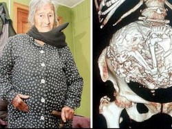 Wanita Ini Tak Sadar Tubuhnya 50 Tahun Membawa Janin Mati