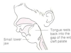 Pierre Robin Sequence, Kondisi Langka di Balik Dagu Kecil Kirana