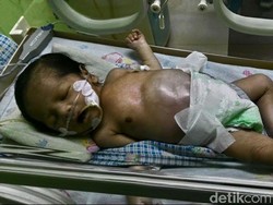 Kelegaan Tukang Bubur Setelah Bayinya Dioperasi Lewat Bantuan Bupati