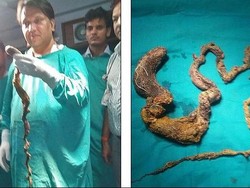 Sakit Perut Hebat, Ternyata Ada Bola Rambut 1,5 Meter di Perut Gadis Ini