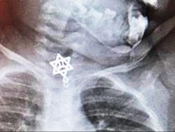 Batuk Tak Juga Reda, Ternyata Ada Liontin di Tenggorokan Bocah 20 Bulan Ini