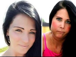 Mimisan Hebat Dikira Alergi, Ibu Satu Anak Ini Ternyata Kena Kanker