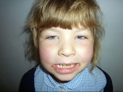 Idap Alergi Pasir, Kulit Bocah Ini Merah dan Terbakar Tiap Pergi ke Laut