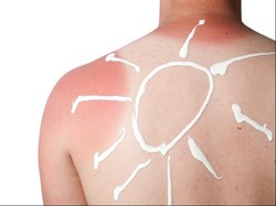 Tren Sunburn Art Menjamur di Media Sosial, Bahaya Kanker Kulit Meningkat