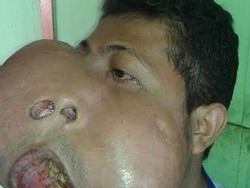 Pria dengan Tumor di Wajah ini Menunggu Bantuan Dokter untuk Operasi