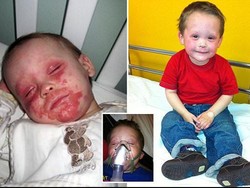 Idap Eksim Parah, Bocah 5 Tahun Ini Berkata Lebih Baik Dirinya Meninggal