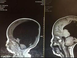 Hampir Tumbuh Cacat, Bocah Ini Sembuh dari Hydrocephalus
