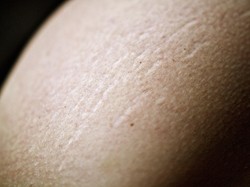 Tak Cuma Ibu Hamil, Stretch Mark Bisa Meneror Pria dan Para Gadis