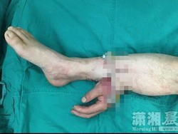 Tangan Pria Tionghoa Sukses Disambung Lagi Setelah Ditempelkan ke Kaki