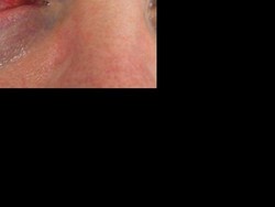 Mata Merah Jadi Gejala Baru COVID-19? Seperti Ini Ciri-cirinya