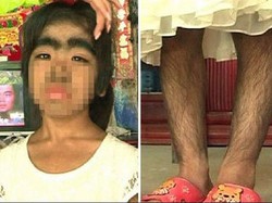 Idap Sindrom Manusia Serigala, Sekujur Tubuh Gadis Ini Tertutup Rambut