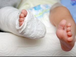 Haru, Bocah yang Lahir dengan Kedua Kaki Terbalik Kini Mampu Berjalan