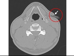 Terjatuh Saat Bersepeda di Gunung, Leher Pria Ini Tertancap Batang Pohon