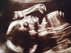 Unik, Ada Dinosaurus Muncul di Foto USG Wanita Hamil Ini!