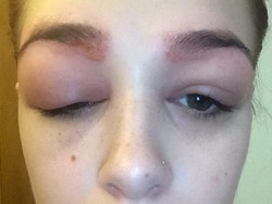 Lakukan Perawatan Alis, Gadis Ini Malah Alergi dan Matanya Bengkak