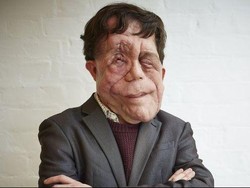 Curhat Adam, Dipanggil Mutan Cacat Karena Wajahnya Penuh Tumor