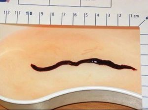 Hii! Sebulan Lamanya Cacing Hitam Besar Hidup di Hidung Bocah Ini