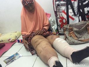 Kata Dokter Soal Penanganan Kaki Gajah Melalui Tindakan Bedah