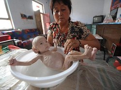 Lahir Tanpa Anus, Bayi ini Seperti Tinggal Tulang-Belulang