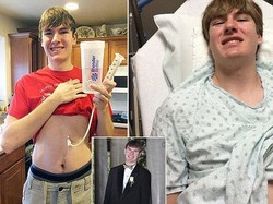 Kondisi Langka, Remaja Ini Didiagnosis Alergi Terhadap Semua Jenis Makanan