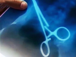 Setelah 3 Tahun Operasi Caesar, Baru Ketahuan Forceps Tertinggal di Perut