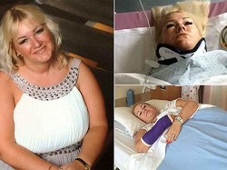 Sleepwalking, Wanita Ini Patah Tulang Akibat Jatuh dari Tangga Saat Tidur