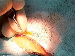 Cacing Parasit 12 Cm Diangkat dari Kelopak Mata Wanita Ini