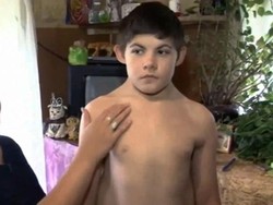 Kisah Remaja Rusia yang Tumbuh dengan Dua Pasang Tulang Rusuk