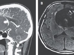 Kepribadian Berubah, Pembuluh Darah di Otak Pria Ini Ternyata Membengkak
