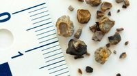 5 Kebiasaan Buruk Ini Berisiko Timbulkan Batu Ginjal
