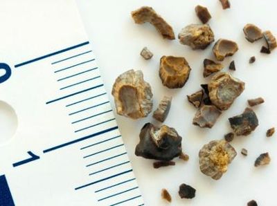 8 Tanda Kemungkinan Memiliki Batu Ginjal