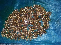 Hiii, dalam Tubuh Pasien asal India Ditemukan 360 Batu Empedu